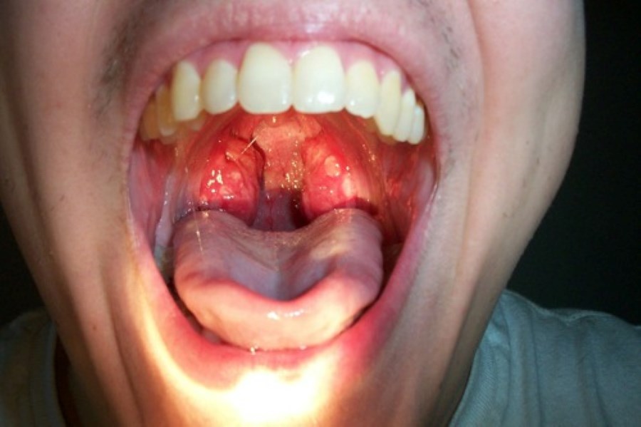 streptococcal pharyngitis throat allergy