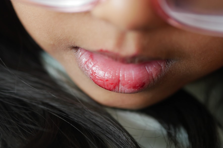 what are the symptoms of lip allergy