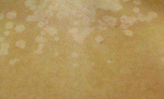 tinea-versicolor