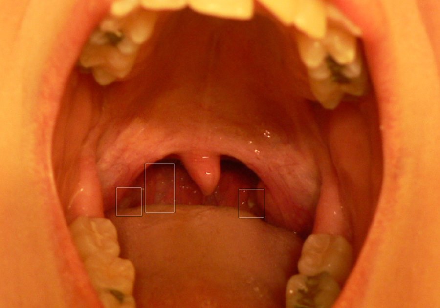 tonsillitis bacterial throat allergy