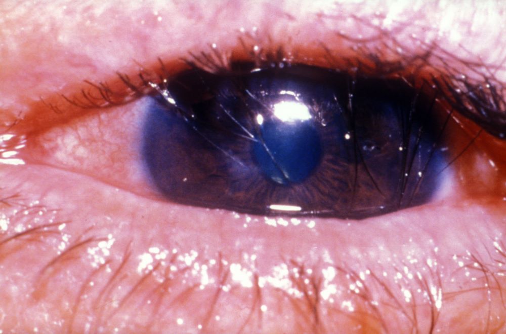 trachoma-eye-Infection