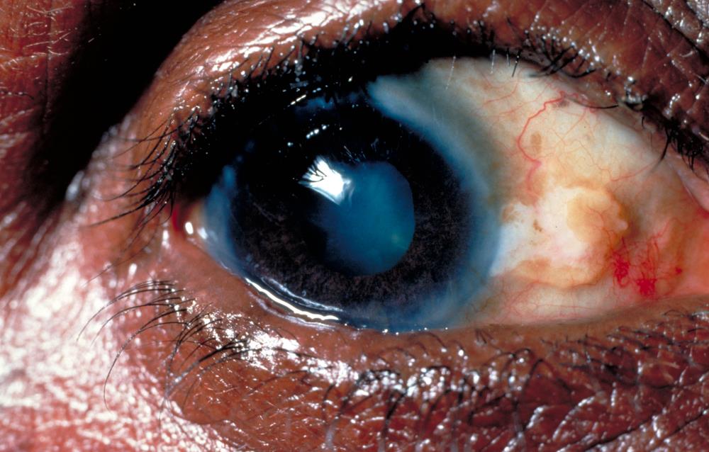 trachoma