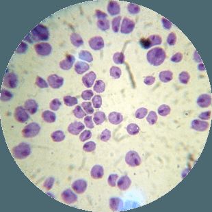 trichomoniasis