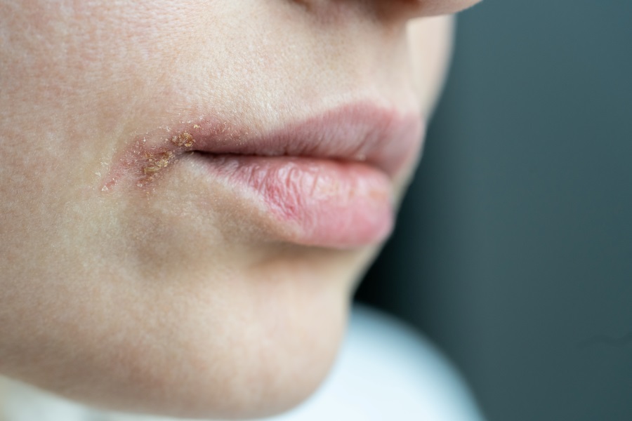 what is lip allergy and its types and treatment