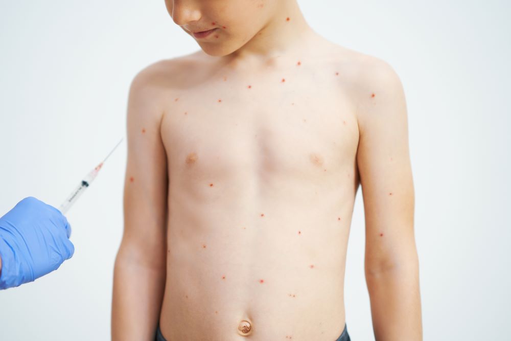 young-boy-having-chickenpox